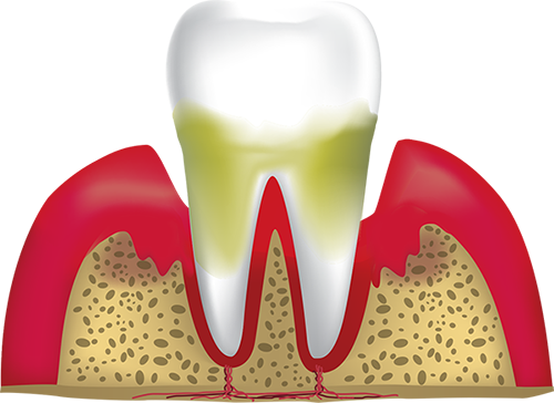 advanced periodontitis Canton, MA