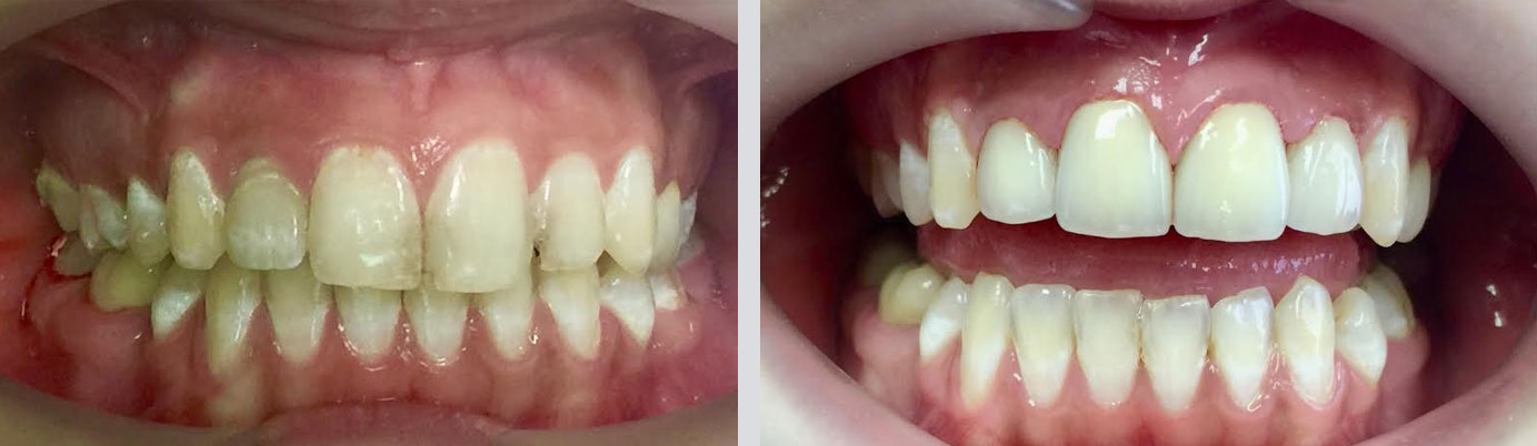 case 2 before and after Canton, MA