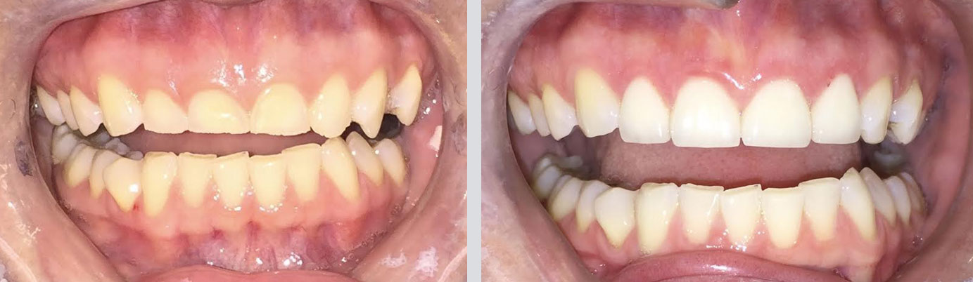 case 5 before and after Canton, MA