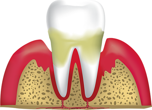 periodontitis Canton, MA